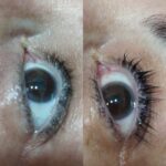 facial2